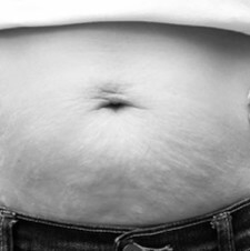 Why I Don’t Want to Lose my Stretch Marks